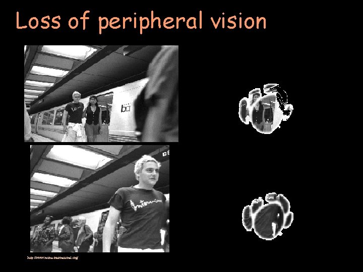 Loss of peripheral vision http: //www. retina-international. org/ 