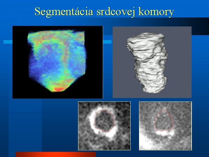 Segmentácia srdcovej komory 