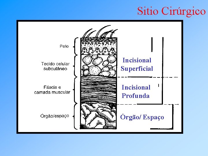 Sitio Cirúrgico Incisional Superficial Incisional Profunda Órgão/ Espaço 