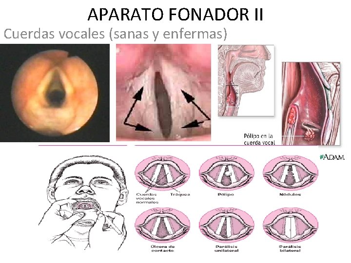 APARATO FONADOR II Cuerdas vocales (sanas y enfermas) 