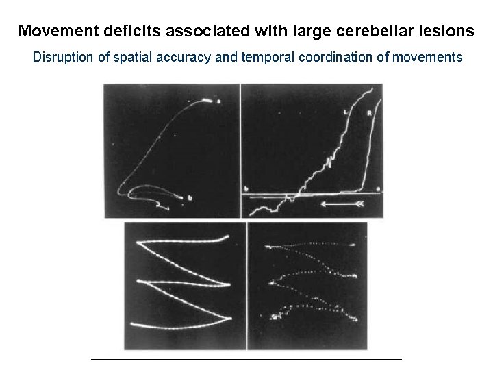 Movement deficits associated with large cerebellar lesions Disruption of spatial accuracy and temporal coordination