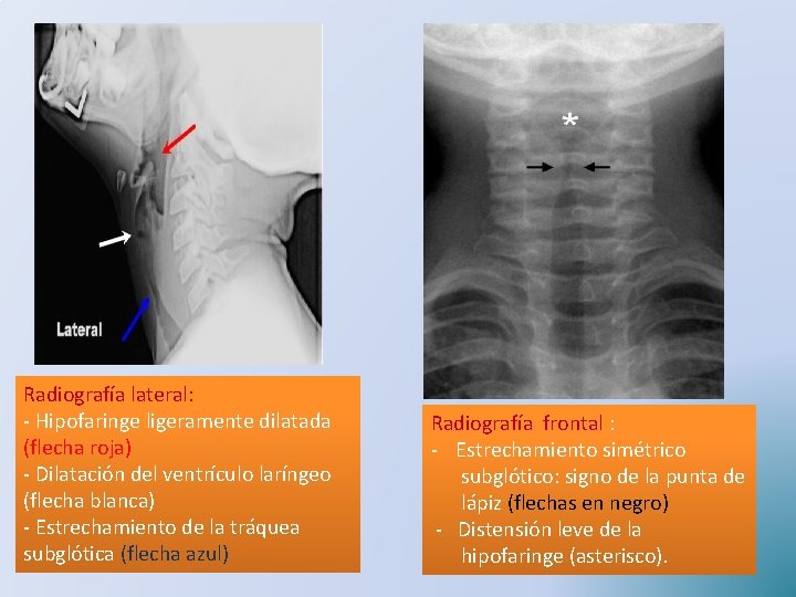 Radiografía lateral: - Hipofaringe ligeramente dilatada (flecha roja) - Dilatación del ventrículo laríngeo (flecha