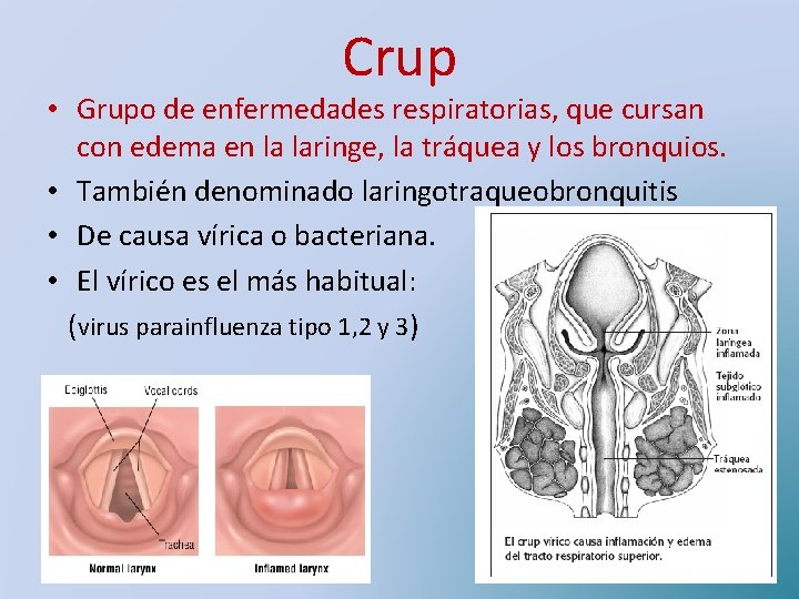 Crup • Grupo de enfermedades respiratorias, que cursan con edema en la laringe, la