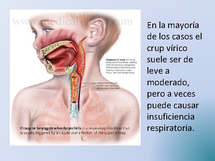 En la mayoría de los casos el crup vírico suele ser de leve a