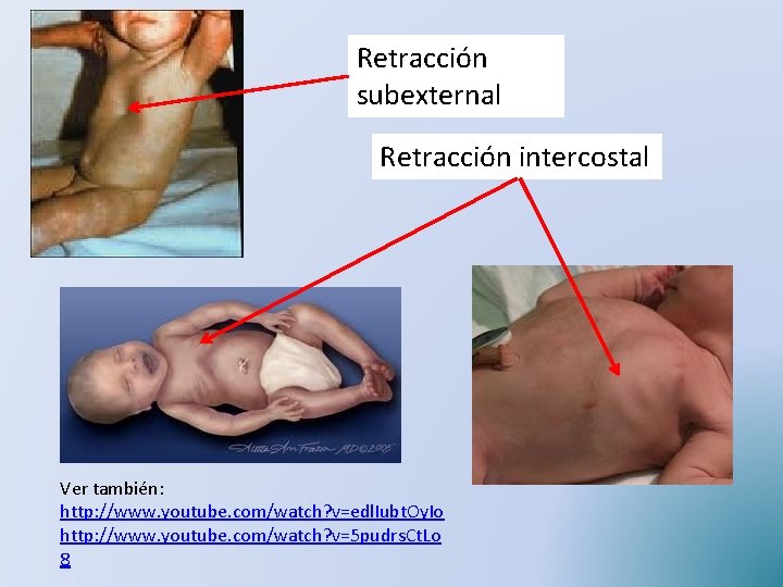 Retracción subexternal Retracción intercostal Ver también: http: //www. youtube. com/watch? v=edl. Iubt. Oy. Io