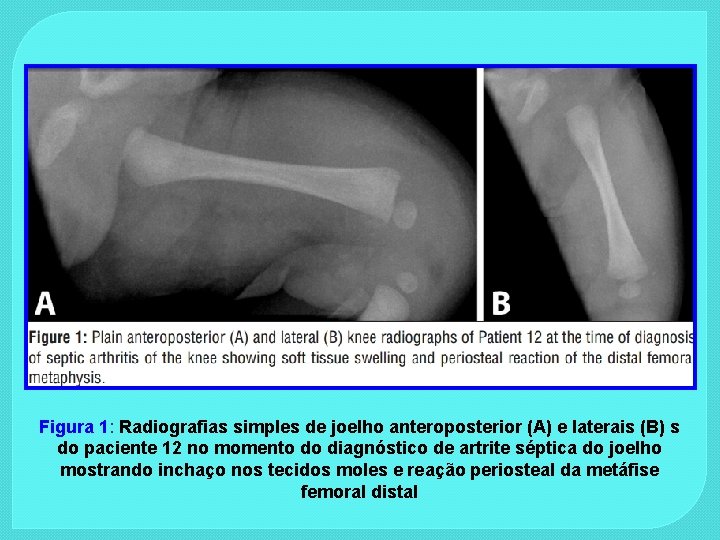 Figura 1: Radiografias simples de joelho anteroposterior (A) e laterais (B) s do paciente