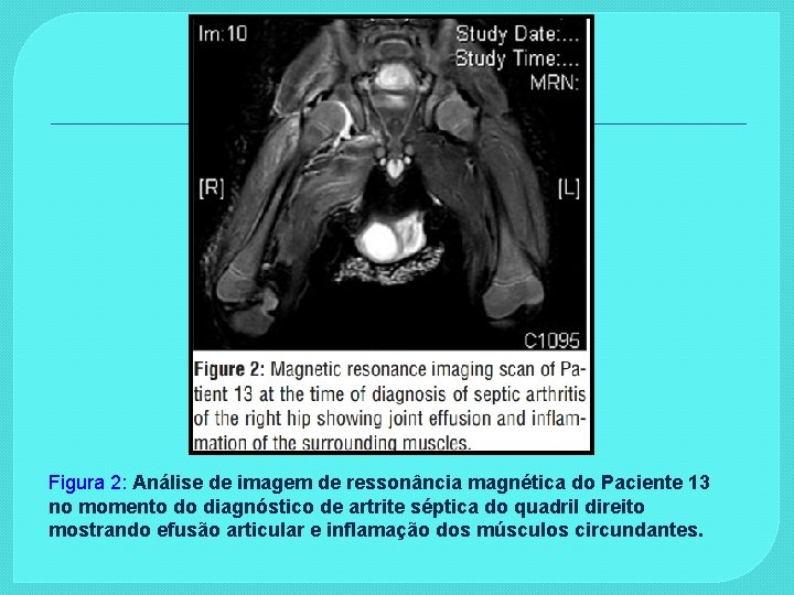 Figura 2: Análise de imagem de ressonância magnética do Paciente 13 no momento do