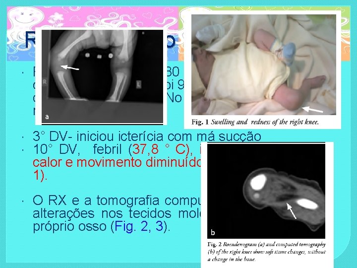 Relato de caso RNT, masculino, 3580 g, parto vaginal sem complicações, Apgar foi 9/9,