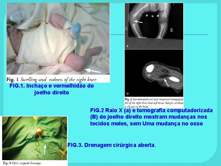 FIG. 1. Inchaço e vermelhidão do joelho direito FIG. 2 Raio X (a) e