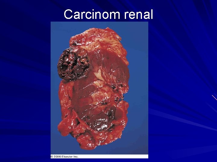 Carcinom renal 