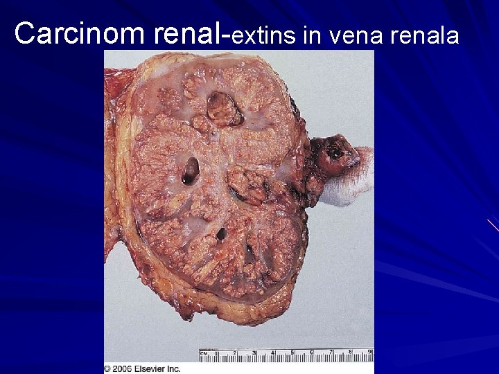 Carcinom renal-extins in vena renala 