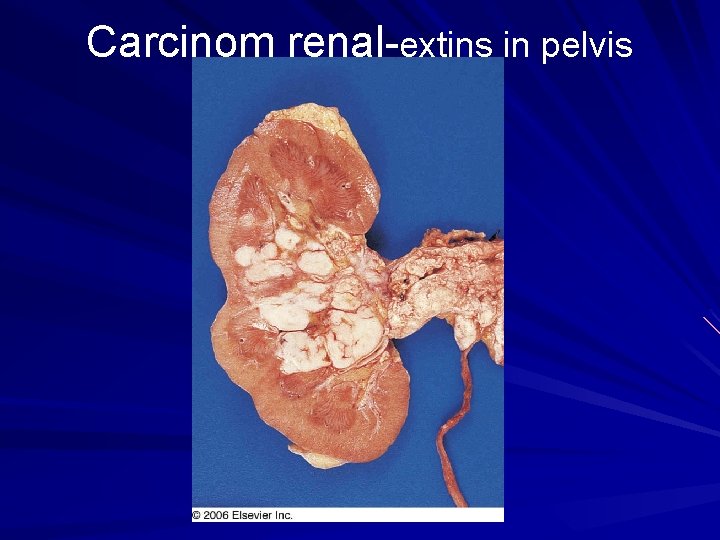 Carcinom renal-extins in pelvis 