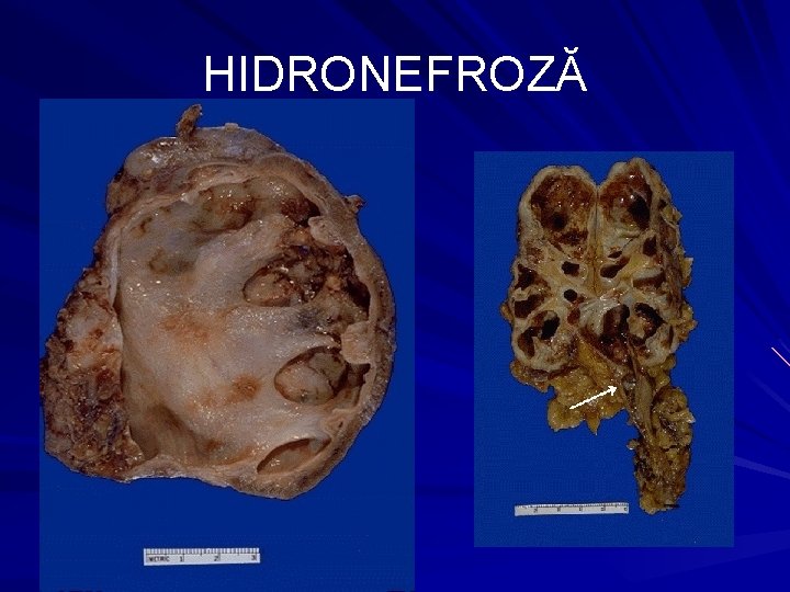 Hidronefroza - acumularea urinei in rinichi