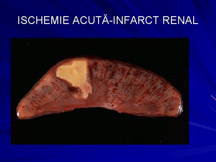 ISCHEMIE ACUTĂ-INFARCT RENAL 