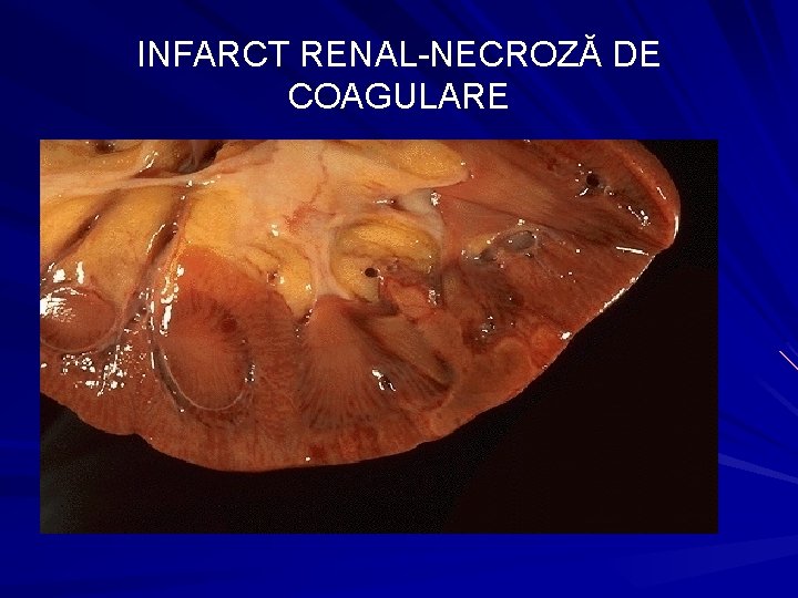 INFARCT RENAL-NECROZĂ DE COAGULARE 