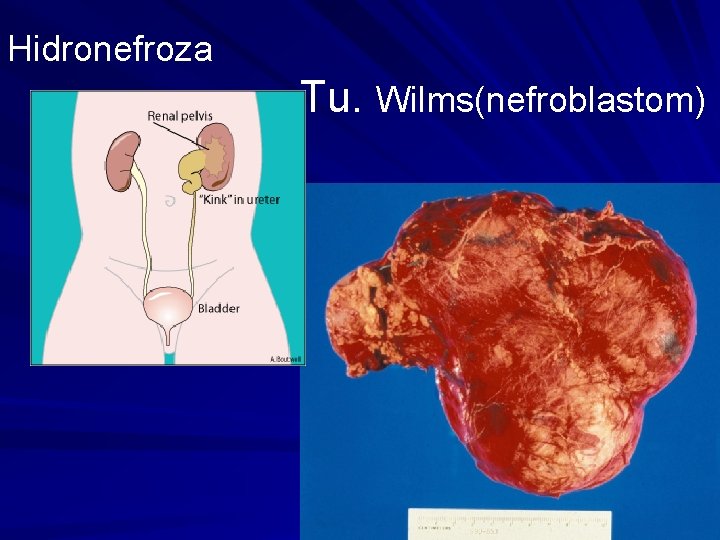 Hidronefroza Tu. Wilms(nefroblastom) 