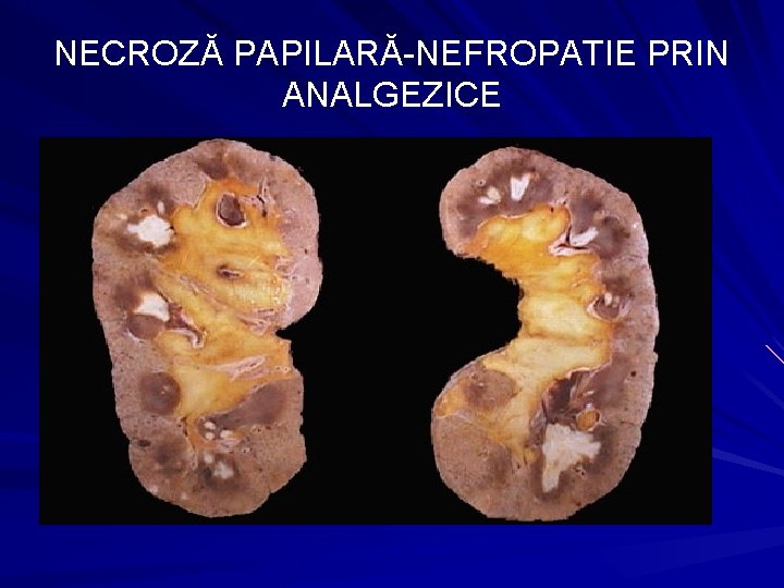 NECROZĂ PAPILARĂ-NEFROPATIE PRIN ANALGEZICE 