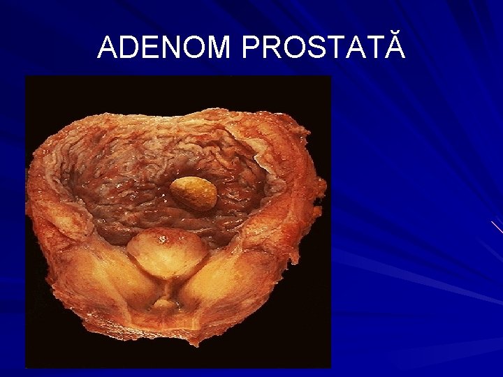 ce este adenom de prostata