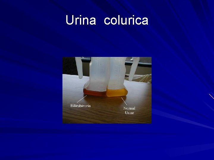 Urina colurica 