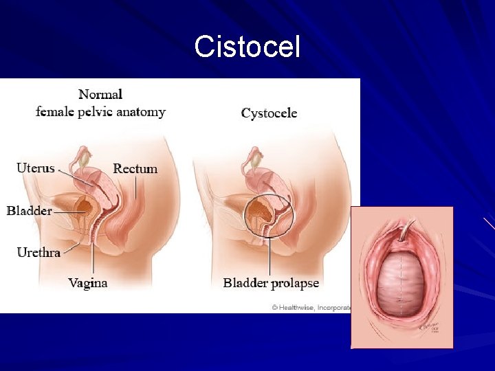 Cistocel 