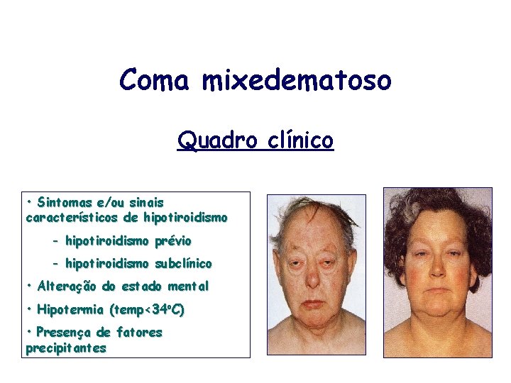 Coma mixedematoso Quadro clínico • Sintomas e/ou sinais característicos de hipotiroidismo - hipotiroidismo prévio