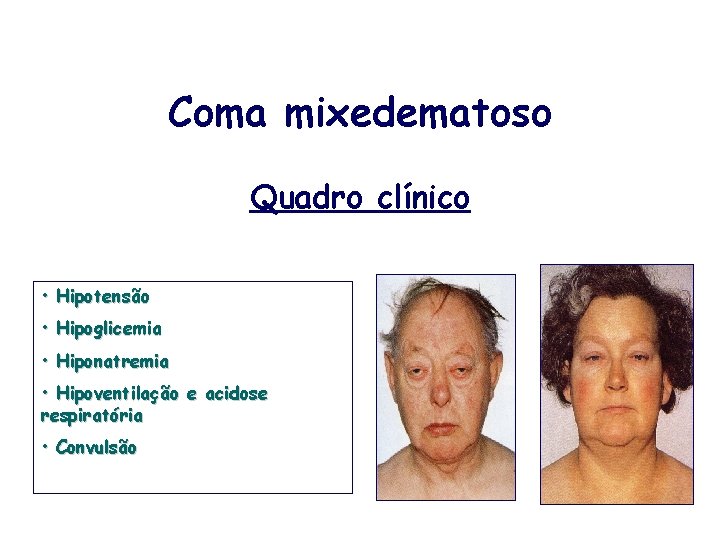 Coma mixedematoso Quadro clínico • Hipotensão • Hipoglicemia • Hiponatremia • Hipoventilação e acidose