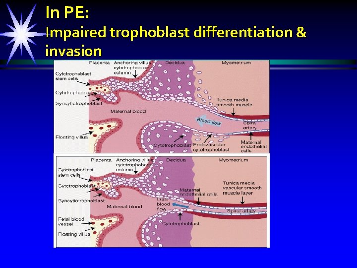 In PE: Impaired trophoblast differentiation & invasion 