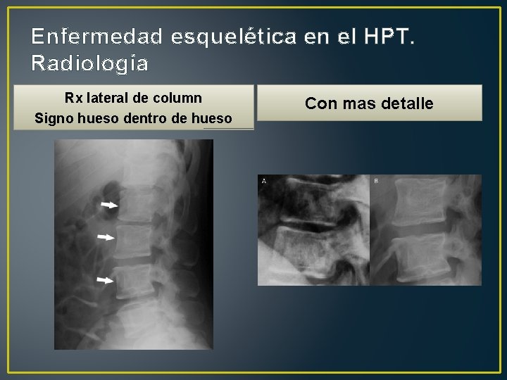 Enfermedad esquelética en el HPT. Radiología Rx lateral de column Signo hueso dentro de