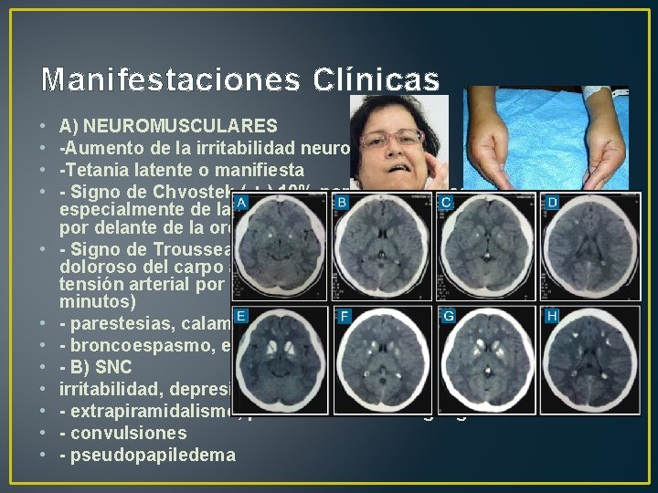 Manifestaciones Clínicas • • • A) NEUROMUSCULARES -Aumento de la irritabilidad neuromuscular. -Tetania latente