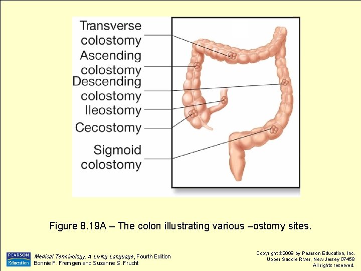 Figure 8. 19 A – The colon illustrating various –ostomy sites. Medical Terminology: A