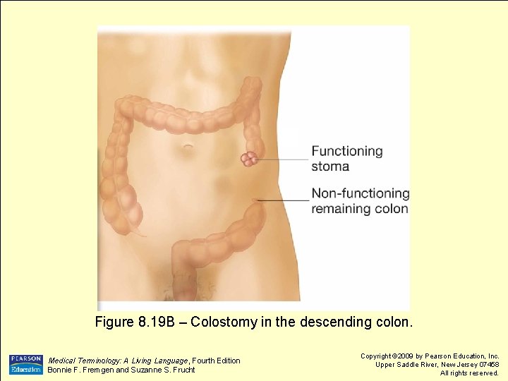 Figure 8. 19 B – Colostomy in the descending colon. Medical Terminology: A Living