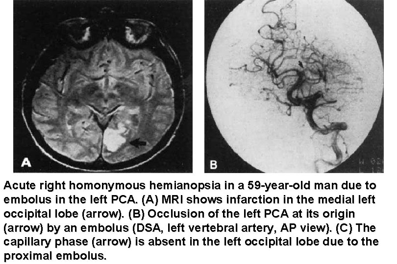 Acute right homonymous hemianopsia in a 59 -year-old man due to embolus in the