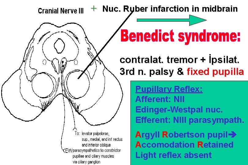 + Nuc. Ruber infarction in midbrain contralat. tremor + İpsilat. 3 rd n. palsy