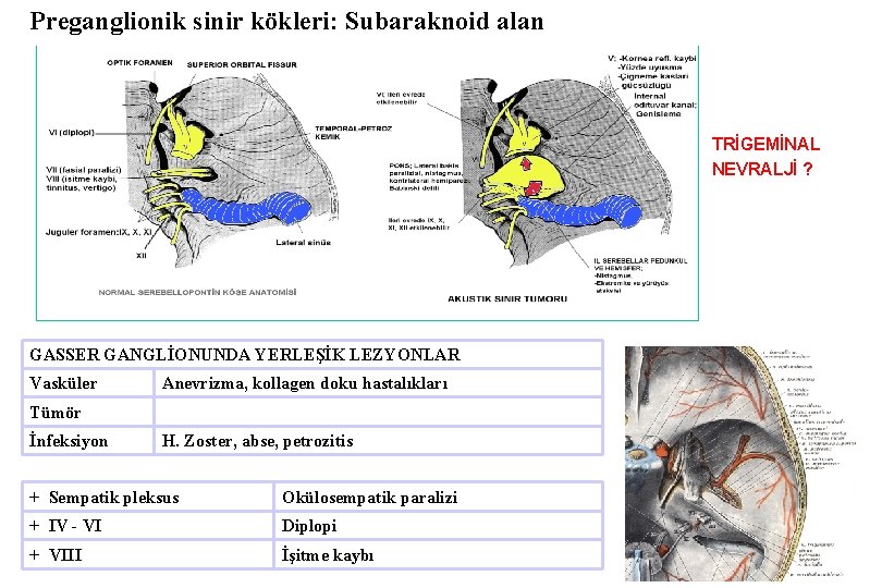 Preganglionik sinir kökleri: Subaraknoid alan TRİGEMİNAL NEVRALJİ ? GASSER GANGLİONUNDA YERLEŞİK LEZYONLAR Vasküler Anevrizma,