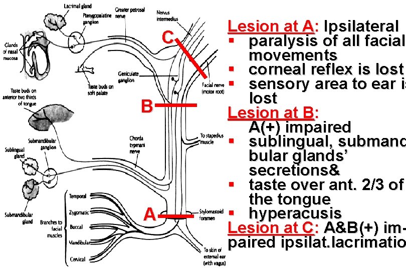 C B A Lesion at A: Ipsilateral § paralysis of all facial movements §