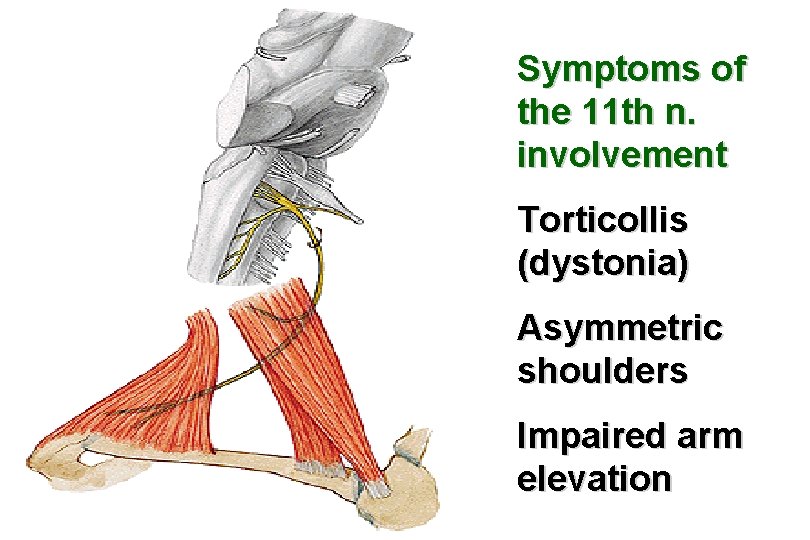 Symptoms of the 11 th n. involvement Torticollis (dystonia) Asymmetric shoulders Impaired arm elevation