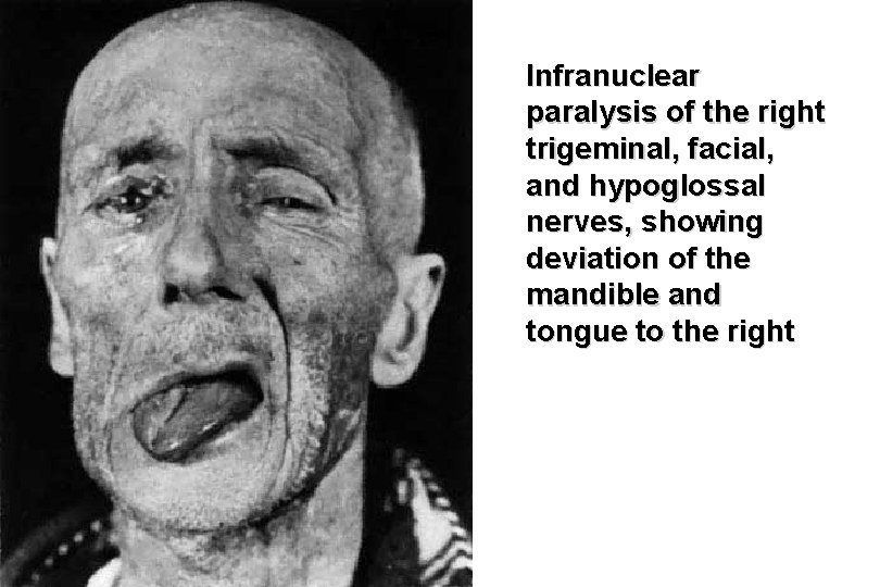 Infranuclear paralysis of the right trigeminal, facial, and hypoglossal nerves, showing deviation of the