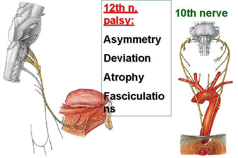 12 th n. palsy: Asymmetry Deviation Atrophy Fasciculatio ns 10 th nerve 