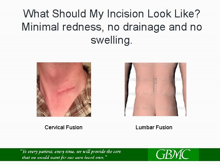 What Should My Incision Look Like? Minimal redness, no drainage and no swelling. Cervical