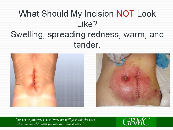 What Should My Incision NOT Look Like? Swelling, spreading redness, warm, and tender. 