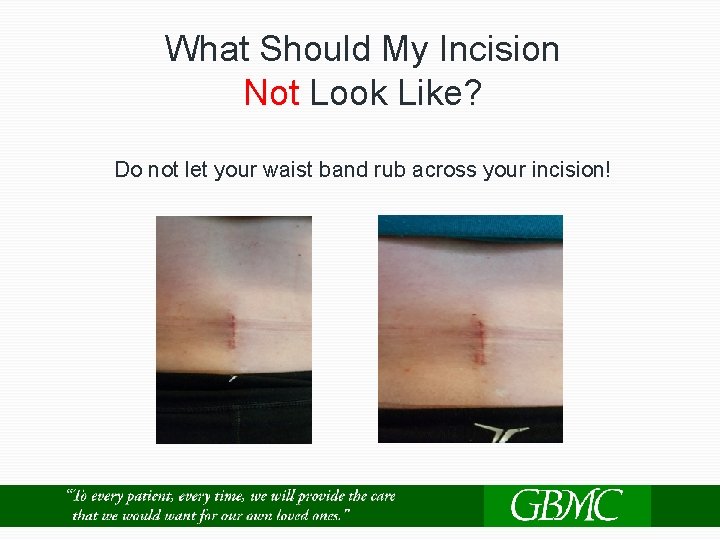 What Should My Incision Not Look Like? Do not let your waist band rub