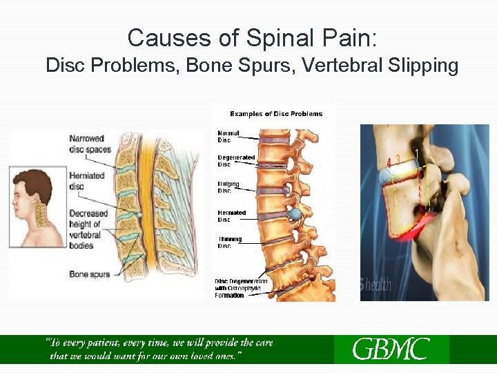 Causes of Spinal Pain: Disc Problems, Bone Spurs, Vertebral Slipping 