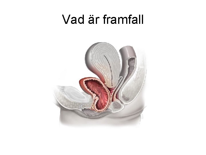 Vad är framfall 