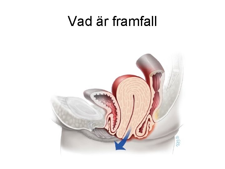 Vad är framfall 