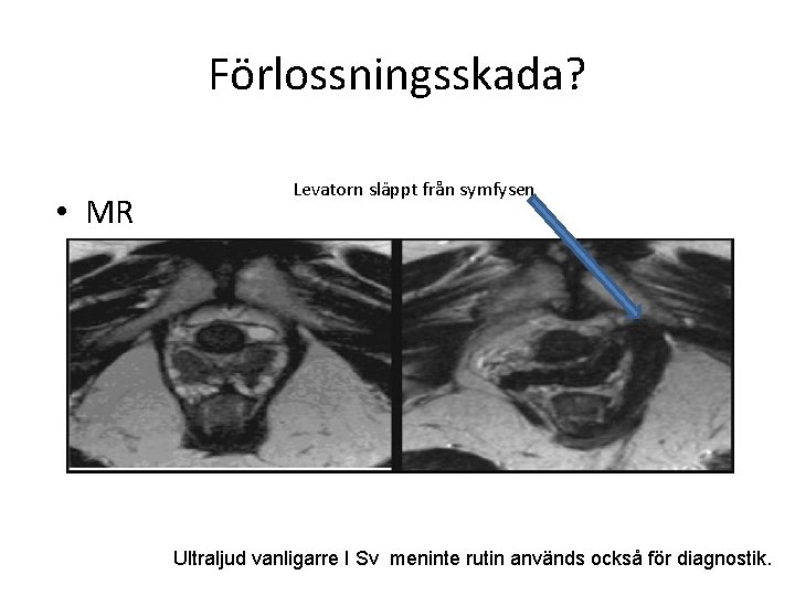 Förlossningsskada? • MR Levatorn släppt från symfysen Ultraljud vanligarre I Sv meninte rutin används