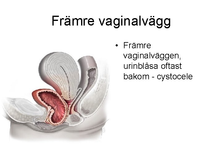 Främre vaginalvägg • Främre vaginalväggen, urinblåsa oftast bakom - cystocele 