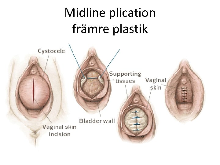 Midline plication främre plastik 