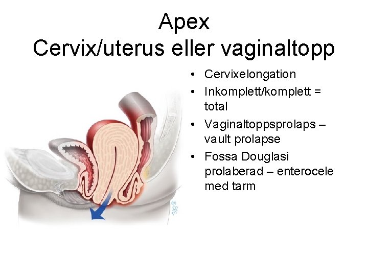 Apex Cervix/uterus eller vaginaltopp • Cervixelongation • Inkomplett/komplett = total • Vaginaltoppsprolaps – vault