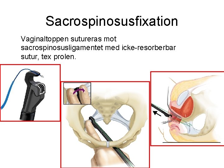 Sacrospinosusfixation Vaginaltoppen sutureras mot sacrospinosusligamentet med icke-resorberbar sutur, tex prolen. 
