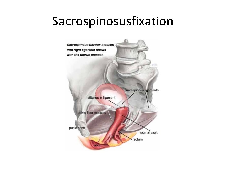 Sacrospinosusfixation 
